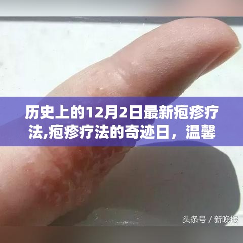 皰疹療法的奇跡日，友情與愛(ài)在歷史上的溫馨故事