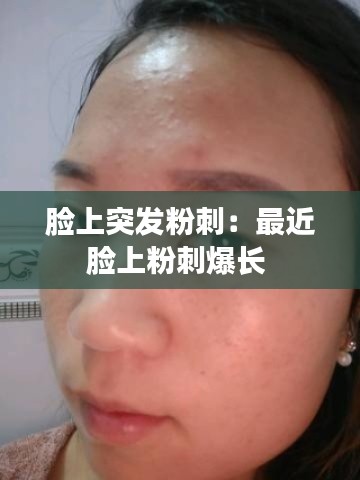 臉上突發(fā)粉刺：最近臉上粉刺爆長 
