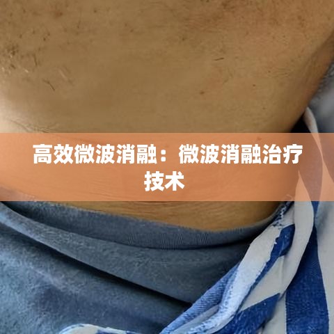 高效微波消融：微波消融治療技術 