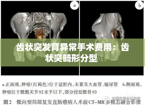 齒狀突發(fā)育異常手術(shù)費(fèi)用：齒狀突畸形分型 